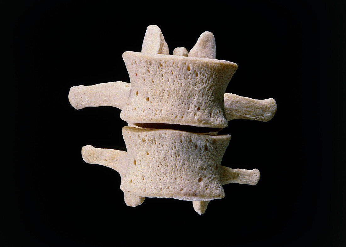 Photograph of the human L3 and L4 vertebrae