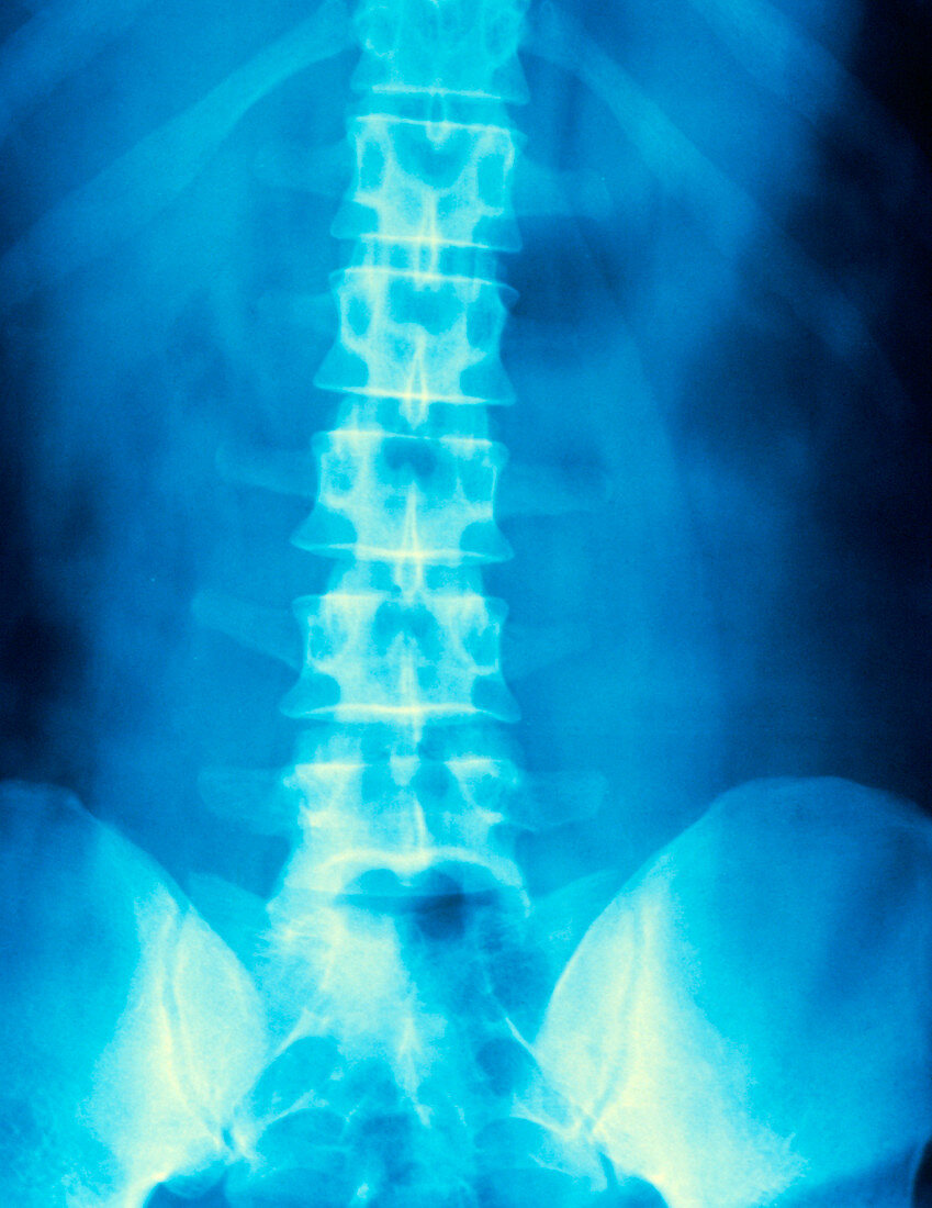 False-colour X-ray of the lumbar & sacral spine