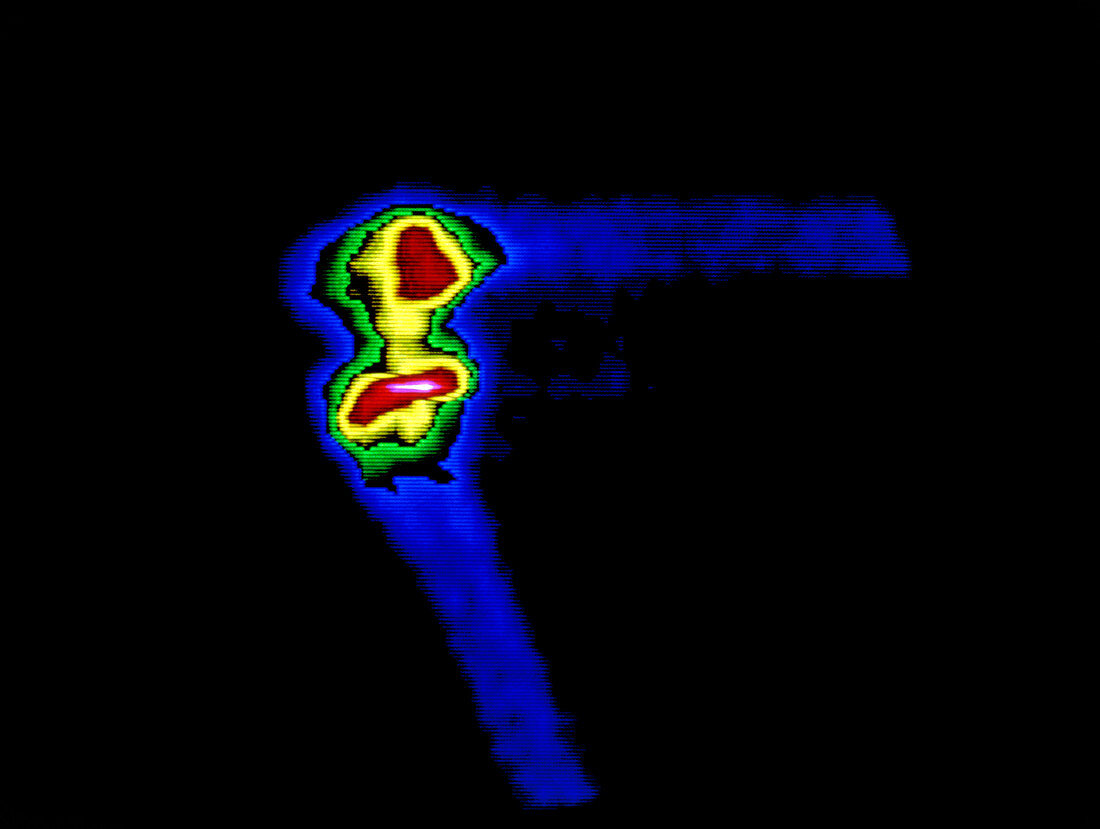 F/colour gamma scan of a normal human knee joint