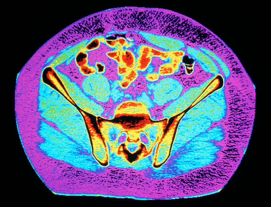 Coloured CT scan of a normal adult pelvis