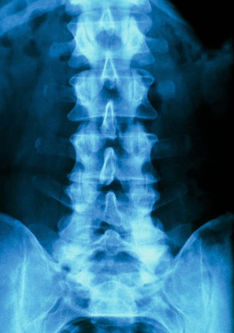 X-ray of normal human lumbar spine (lower back)