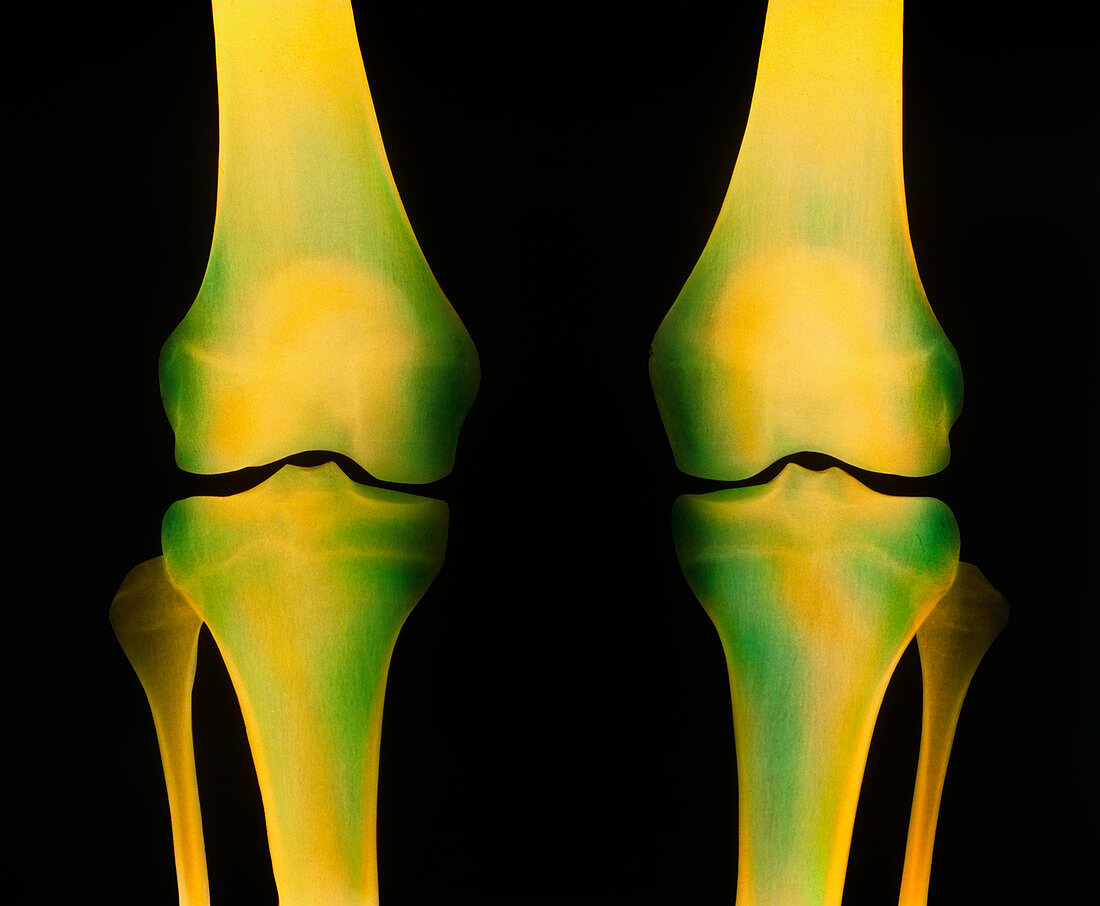 Coloured X-ray of healthy knee joints,both legs