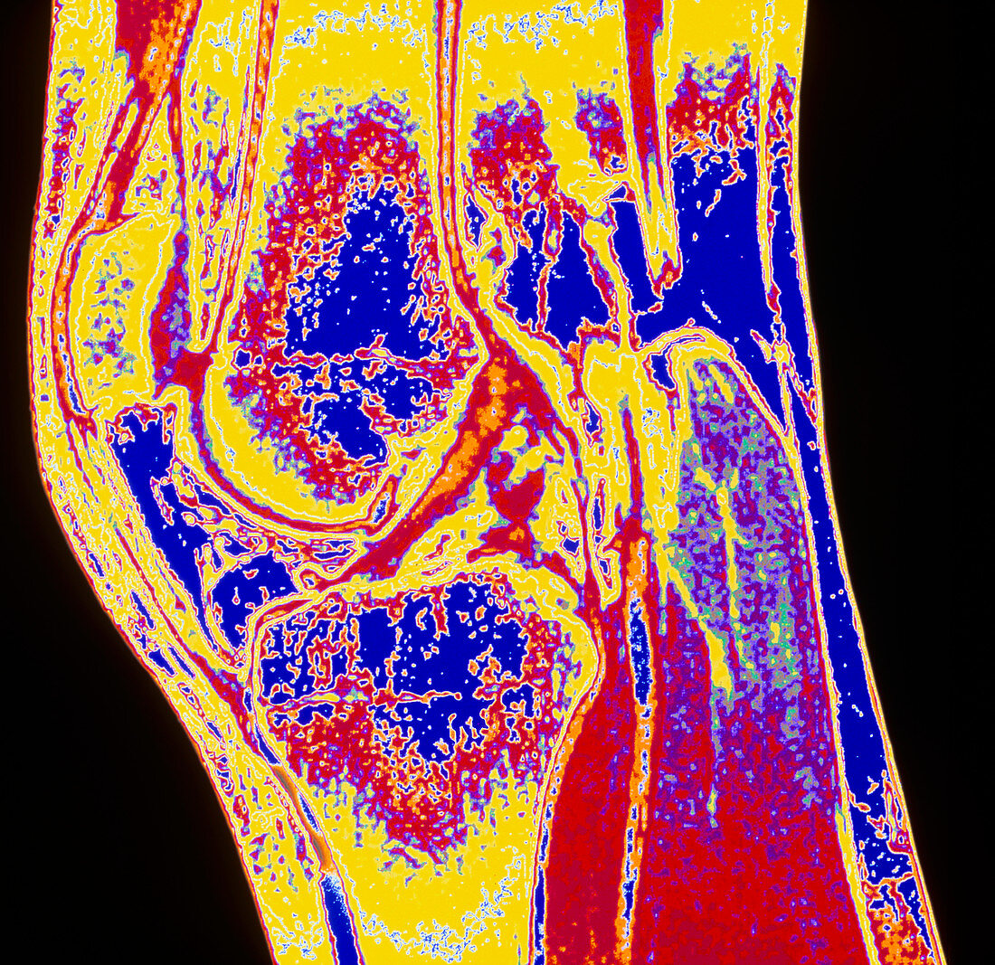 Colour MRI scan of a section through a knee joint