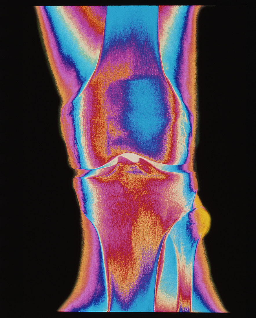 Coloured X-ray of a human knee joint (front view)