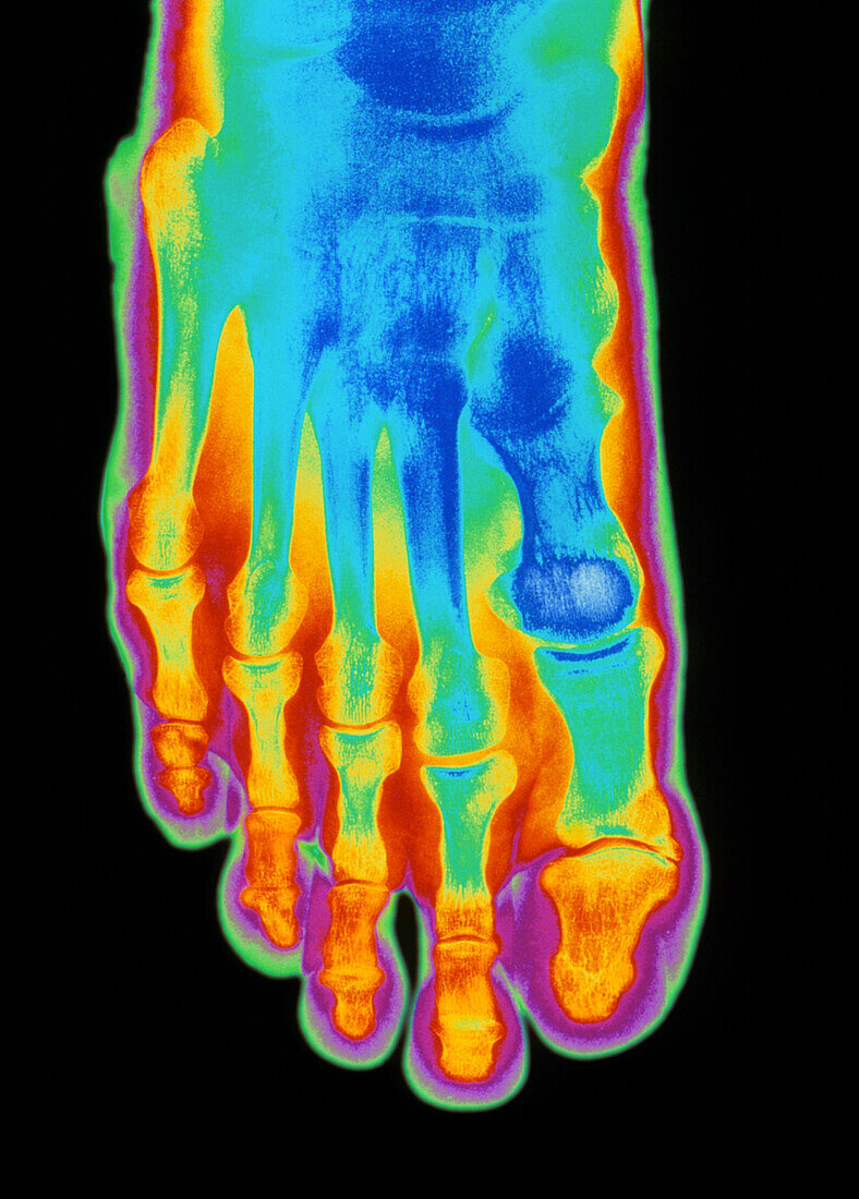 Coloured X-ray of a healthy foot (top view)