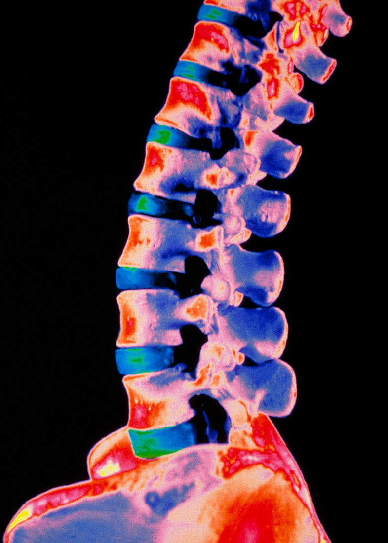 Coloured 3-D CT scan of lower spine