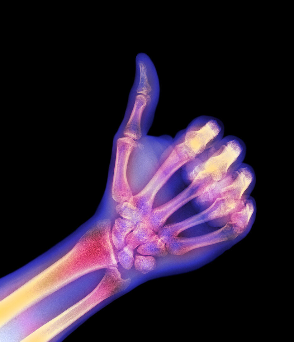 Coloured X-ray of a hand giving a thumb-up sign