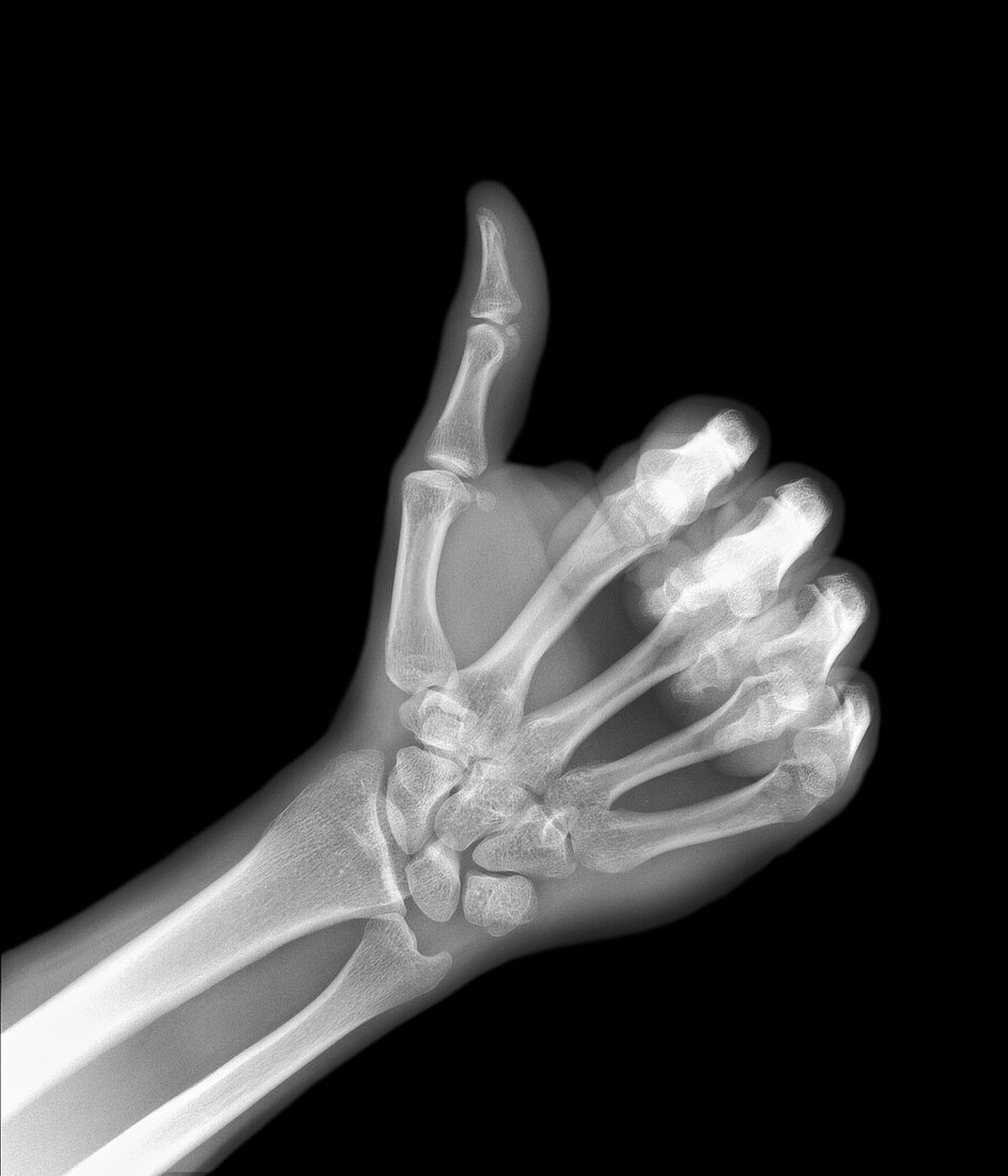 X-ray of a hand giving a thumb-up sign