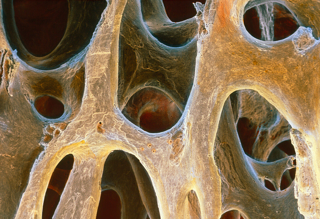 Spongy bone tissue