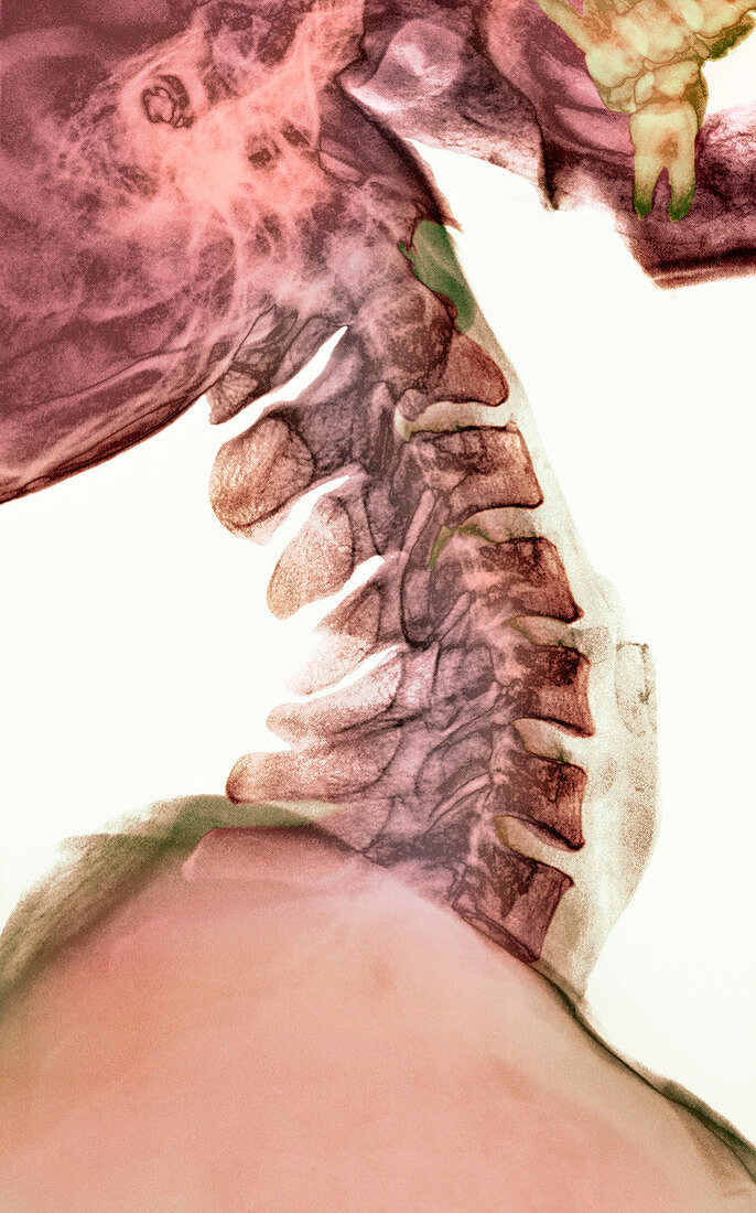 Neck vertebrae flexed,X-ray
