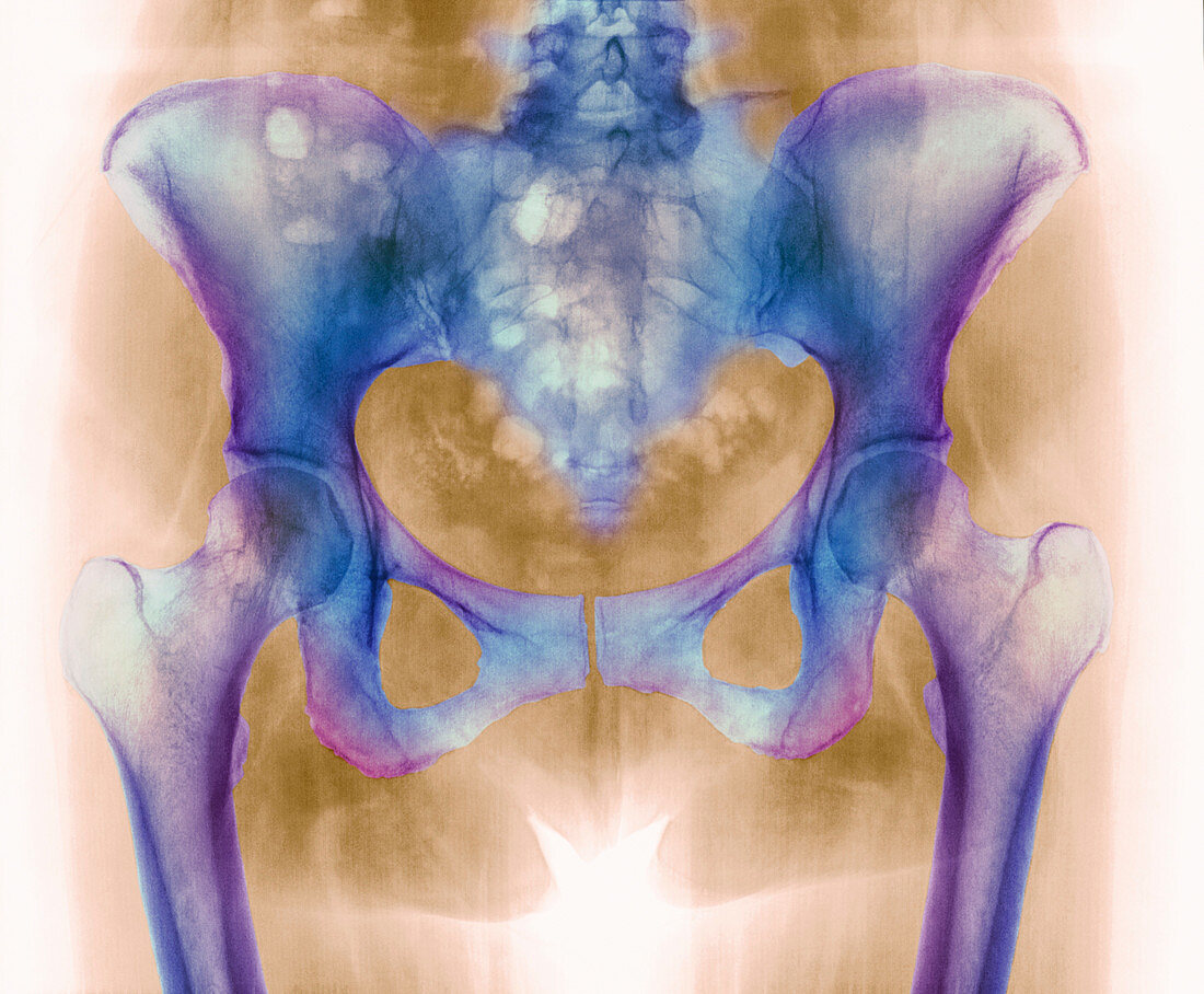 Healthy hip bones,X-ray