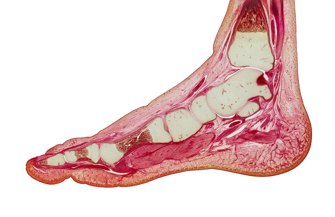 Foetal foot