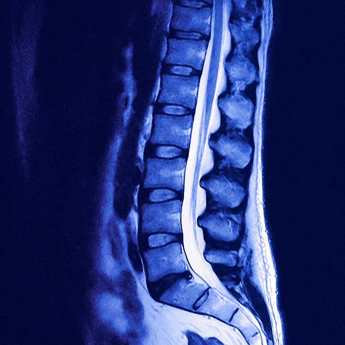 Lower spine,MRI scan