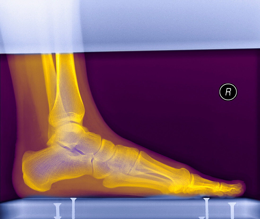 Foot,X-ray