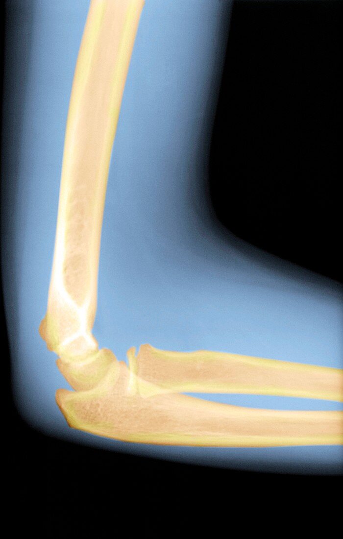 Child's elbow,X-ray