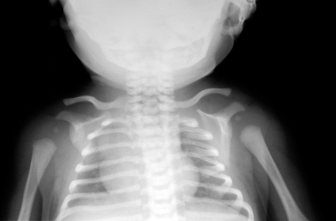 Young child,X-ray