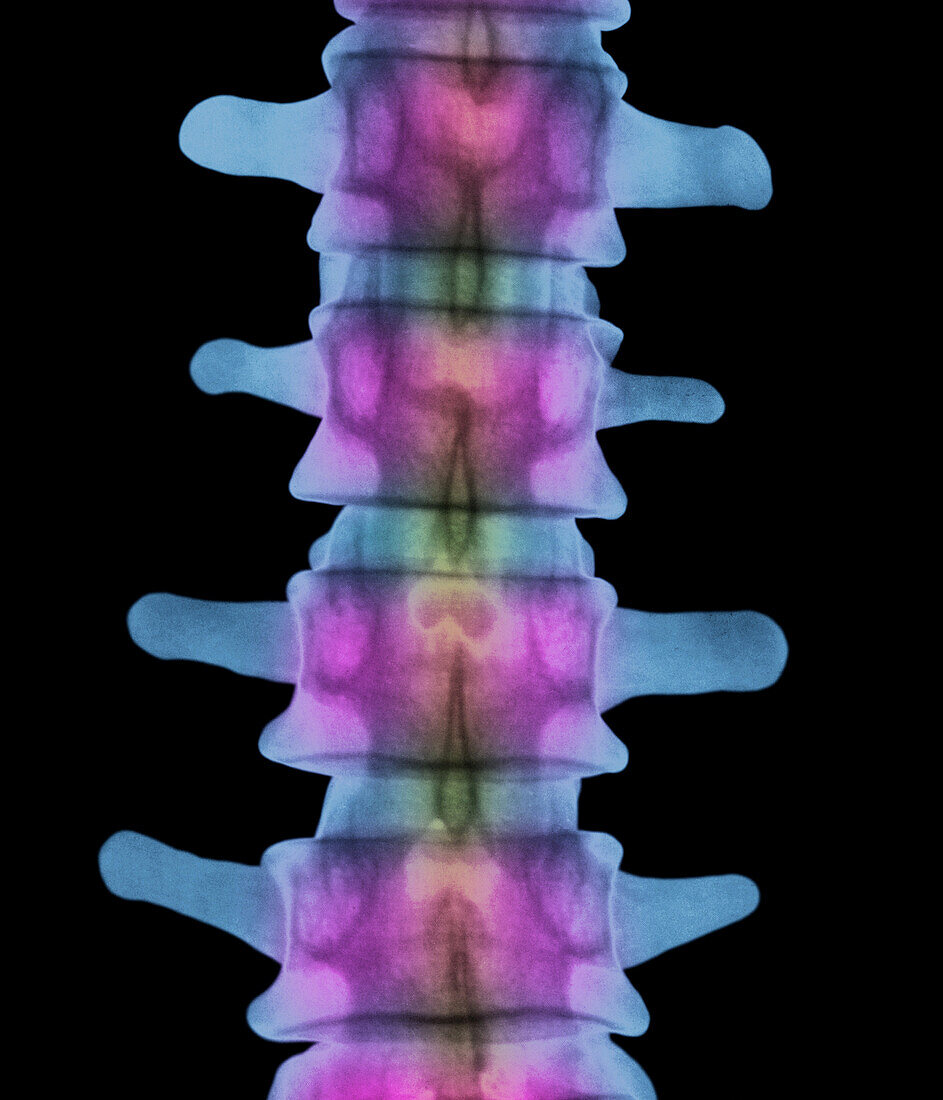 Lumbar spine,X-ray