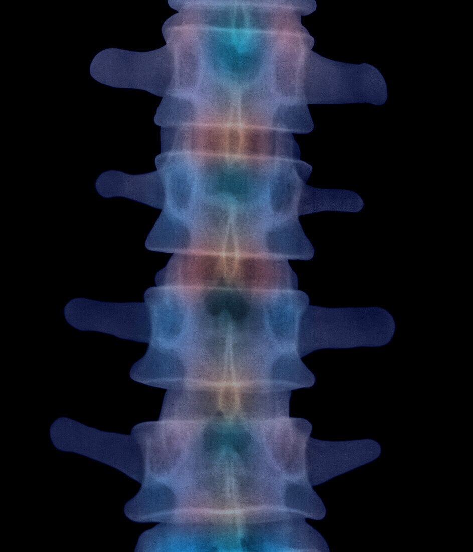 Lumbar spine,X-ray