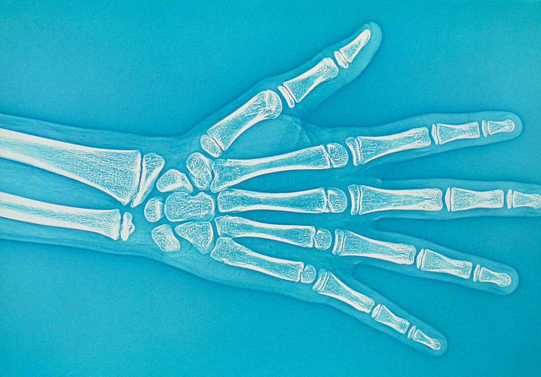 Teenager hand X-ray