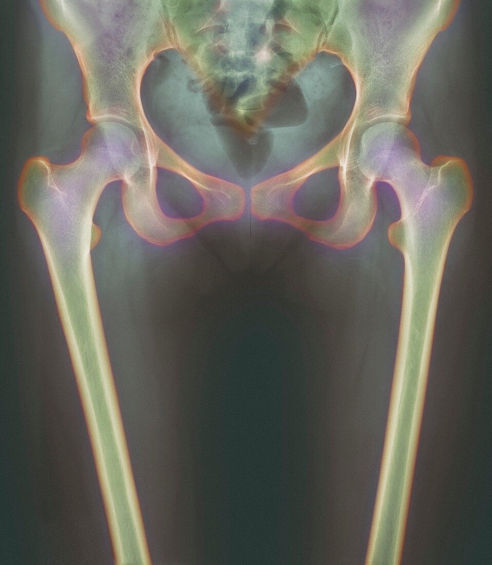 Hip bones,X-ray
