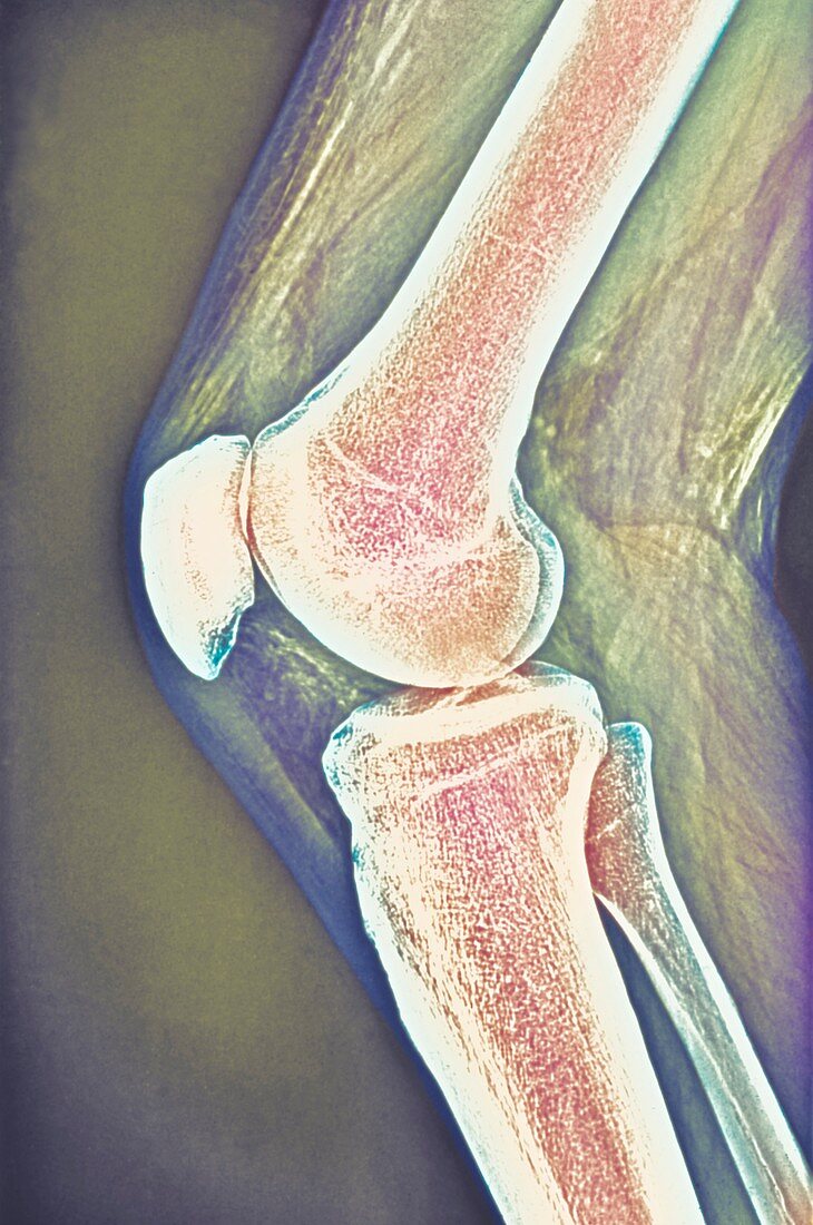 Knee joint,X-ray