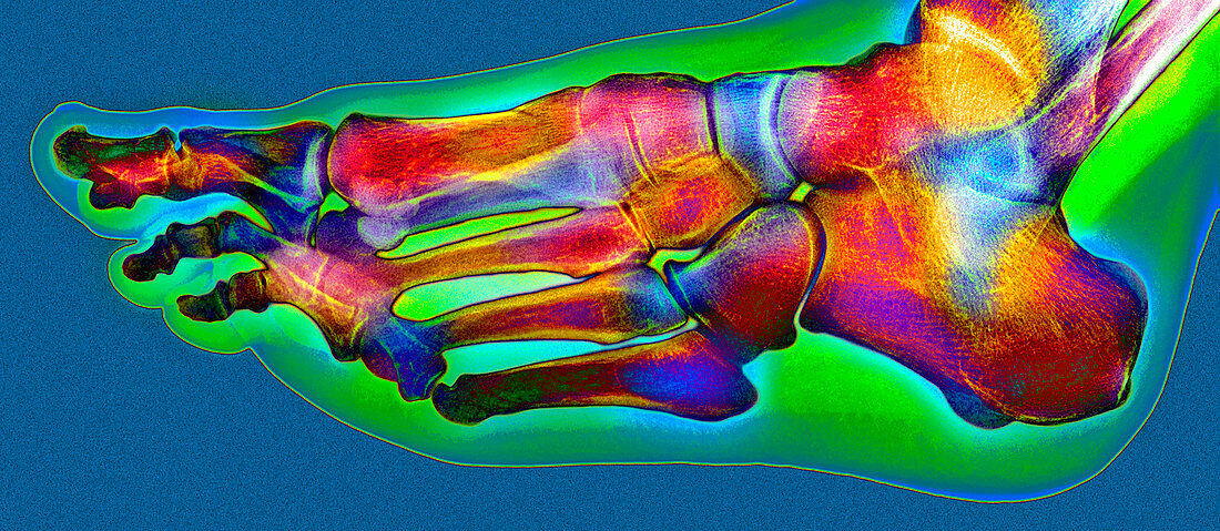 Normal foot,X-ray