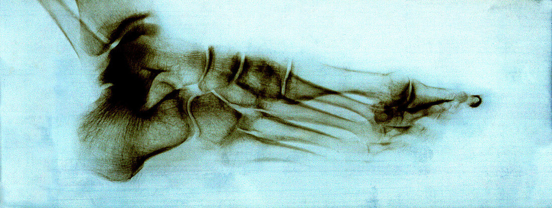Foot bones,X-ray
