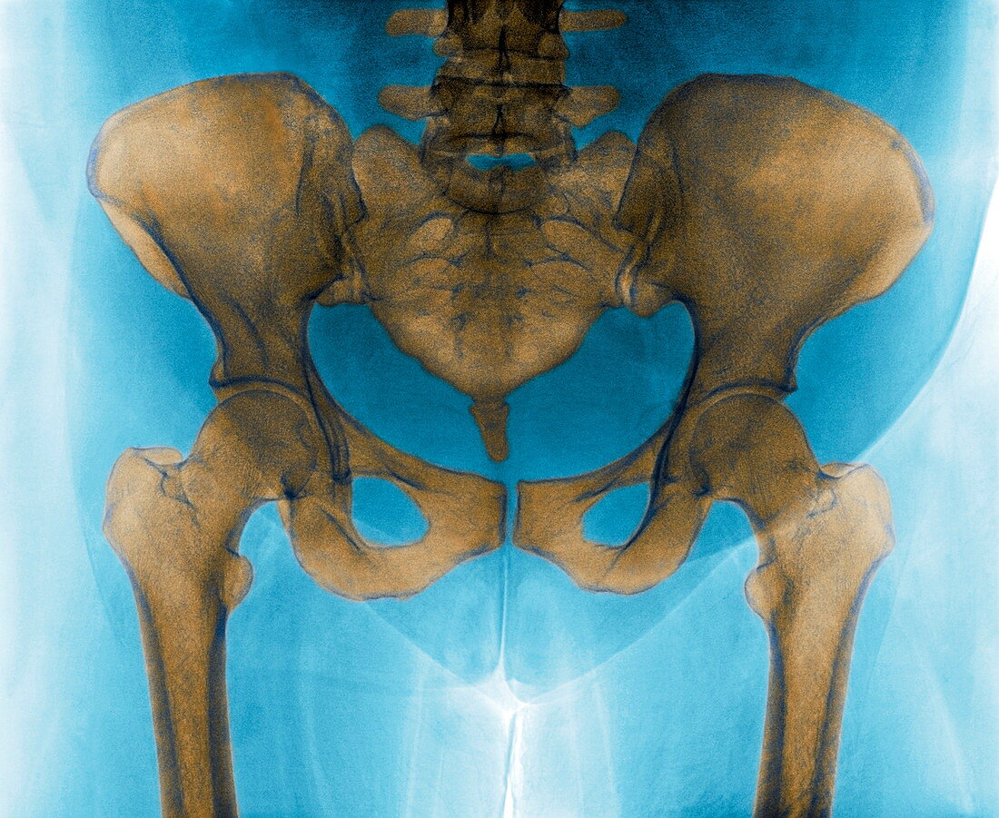 Female Pelvis X Ray Bild Kaufen 11867867 Science Photo Library