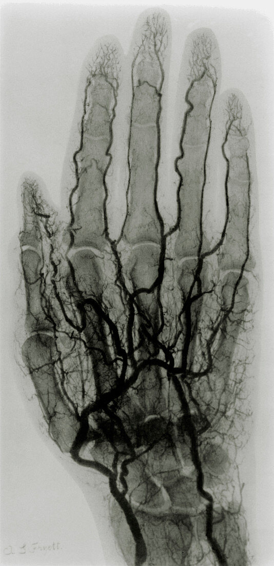 Early X-ray arteriogram of a human hand,1904