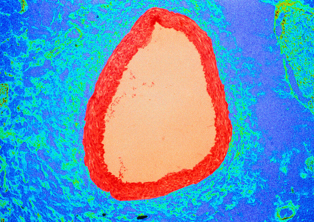 Coloured LM of a section through a coronary artery