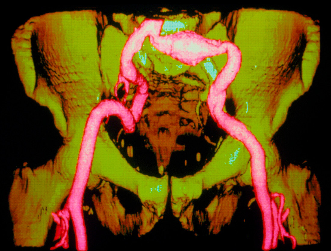 3-D CT scan of major arteries in human pelvis