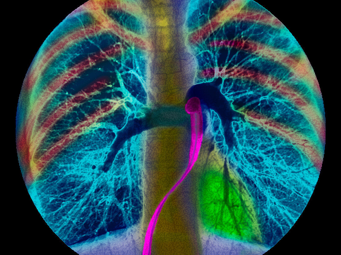 Coloured angiogram showing the pulmonary arteries
