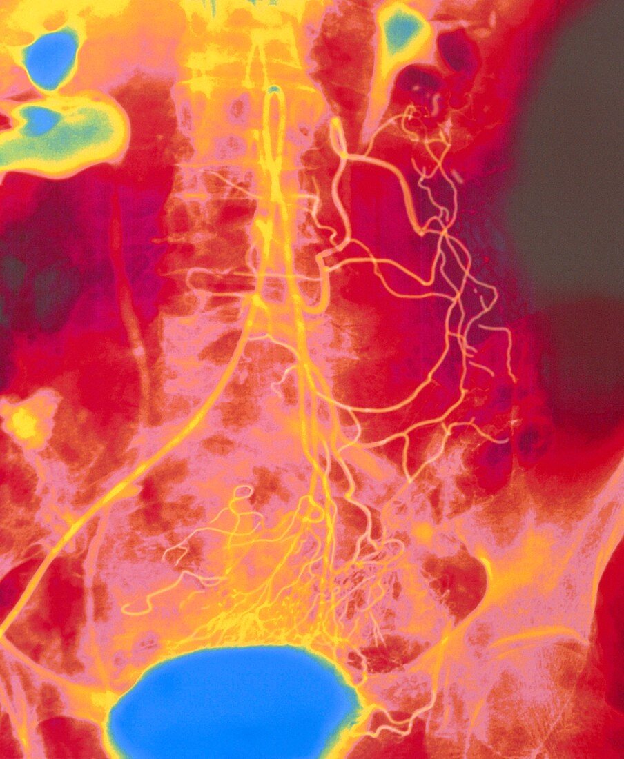 Coloured angiogram (X-ray) of mesenteric arteries