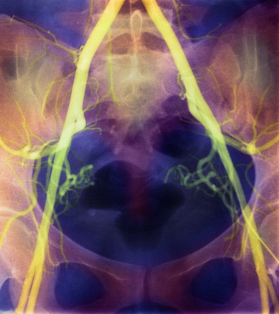 Coloured X-ray of iliac arteries to the pelvis