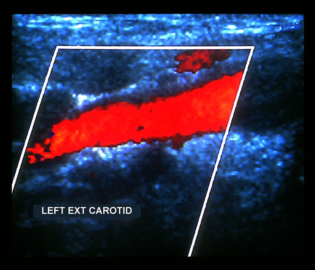 Carotid artery,doppler ultrasound scan