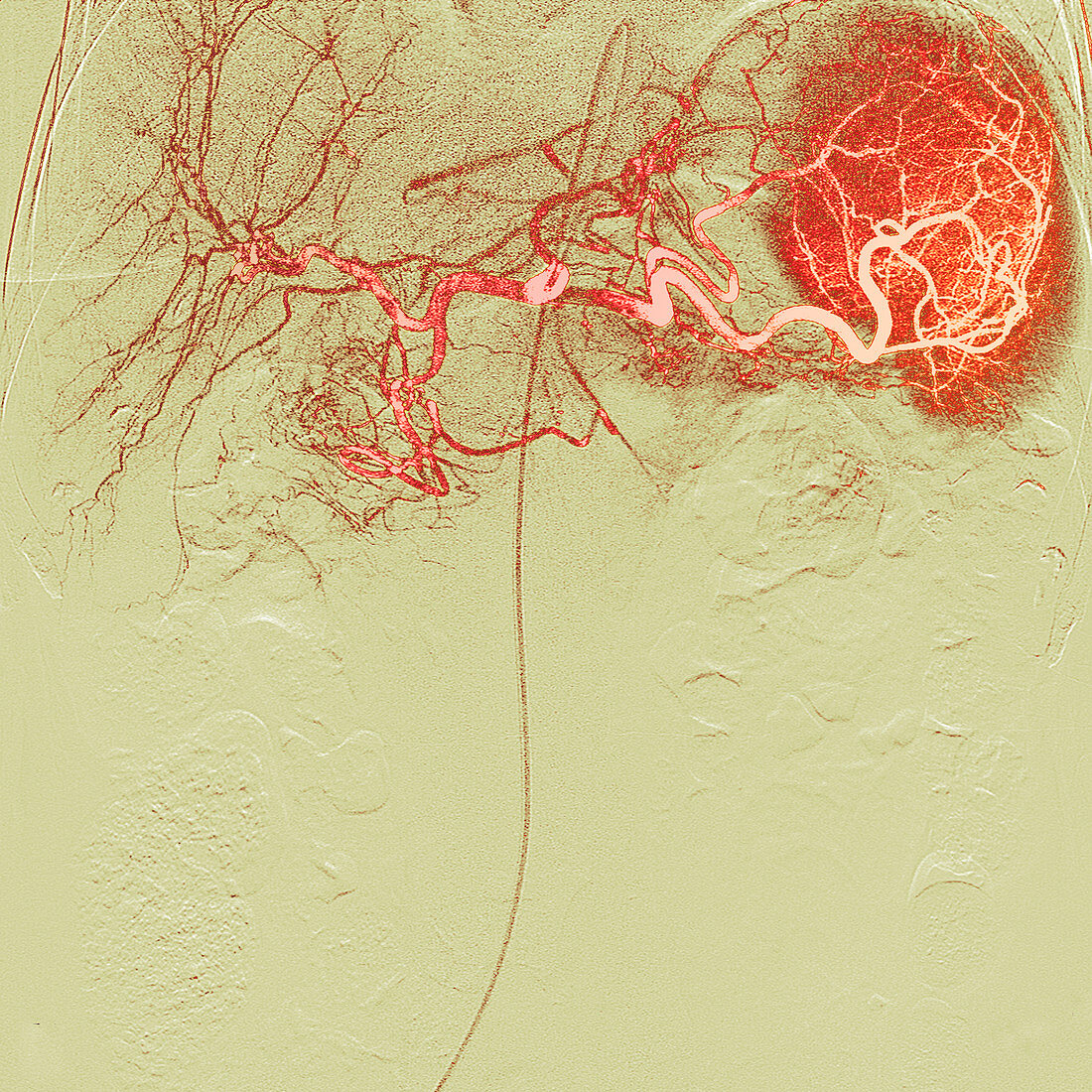 Abdominal arteries,X-ray