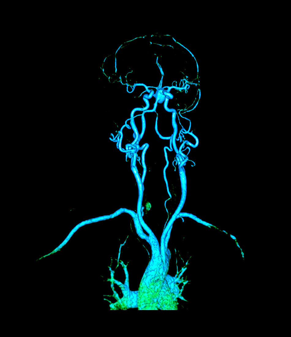Head and neck arteries,CT scan