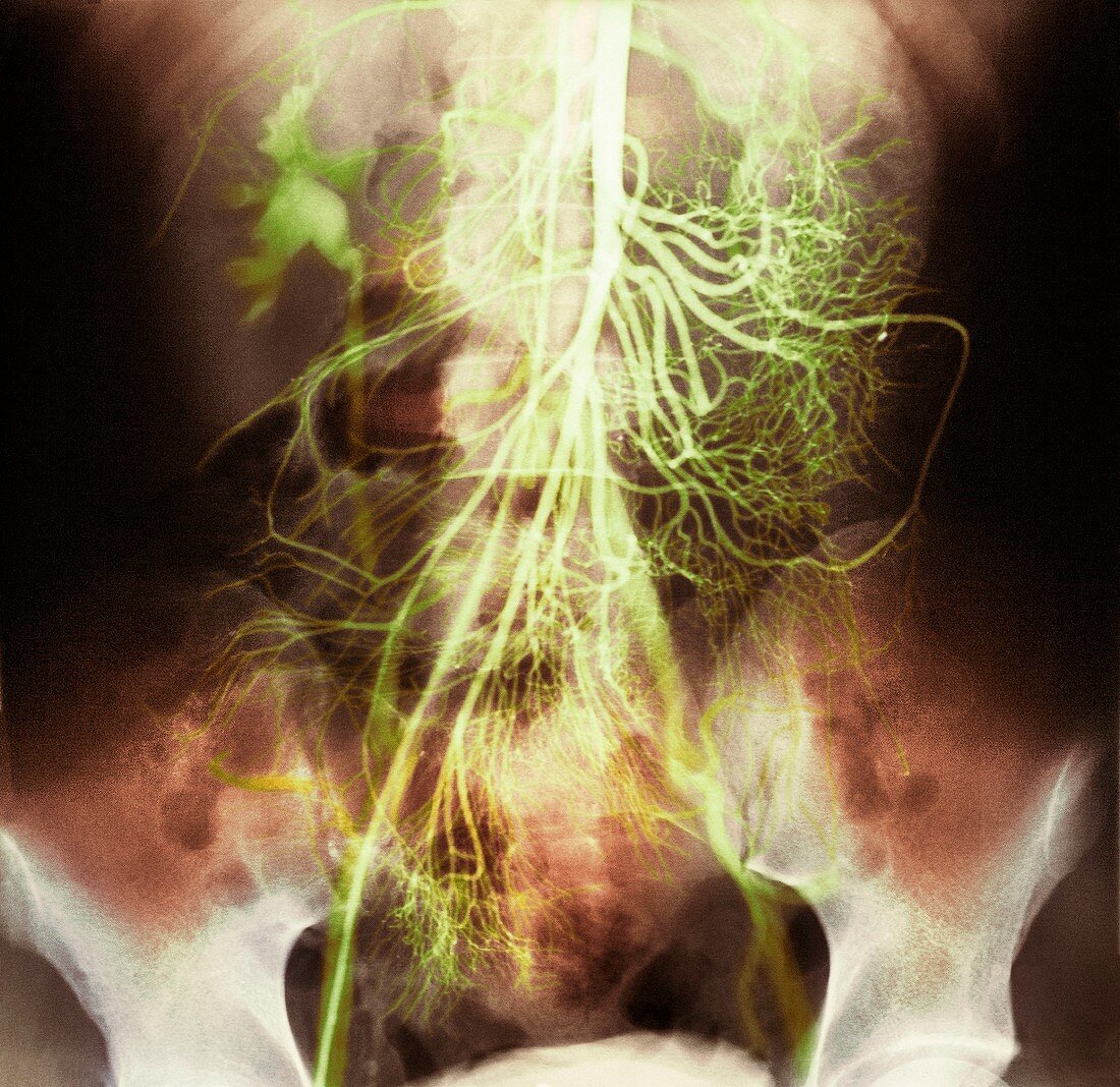 Abdominal arteries,X-ray