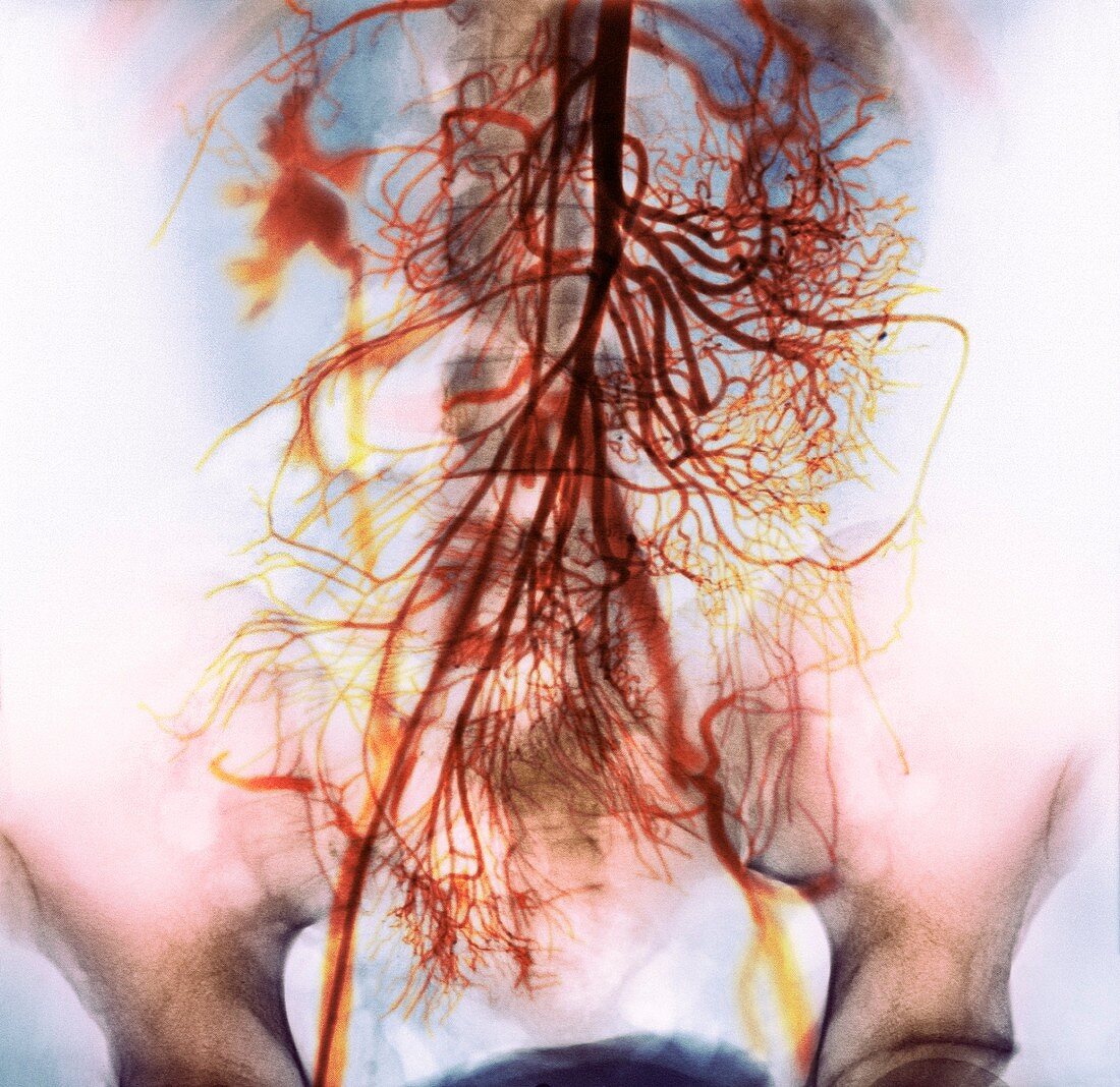 Abdominal arteries,X-ray