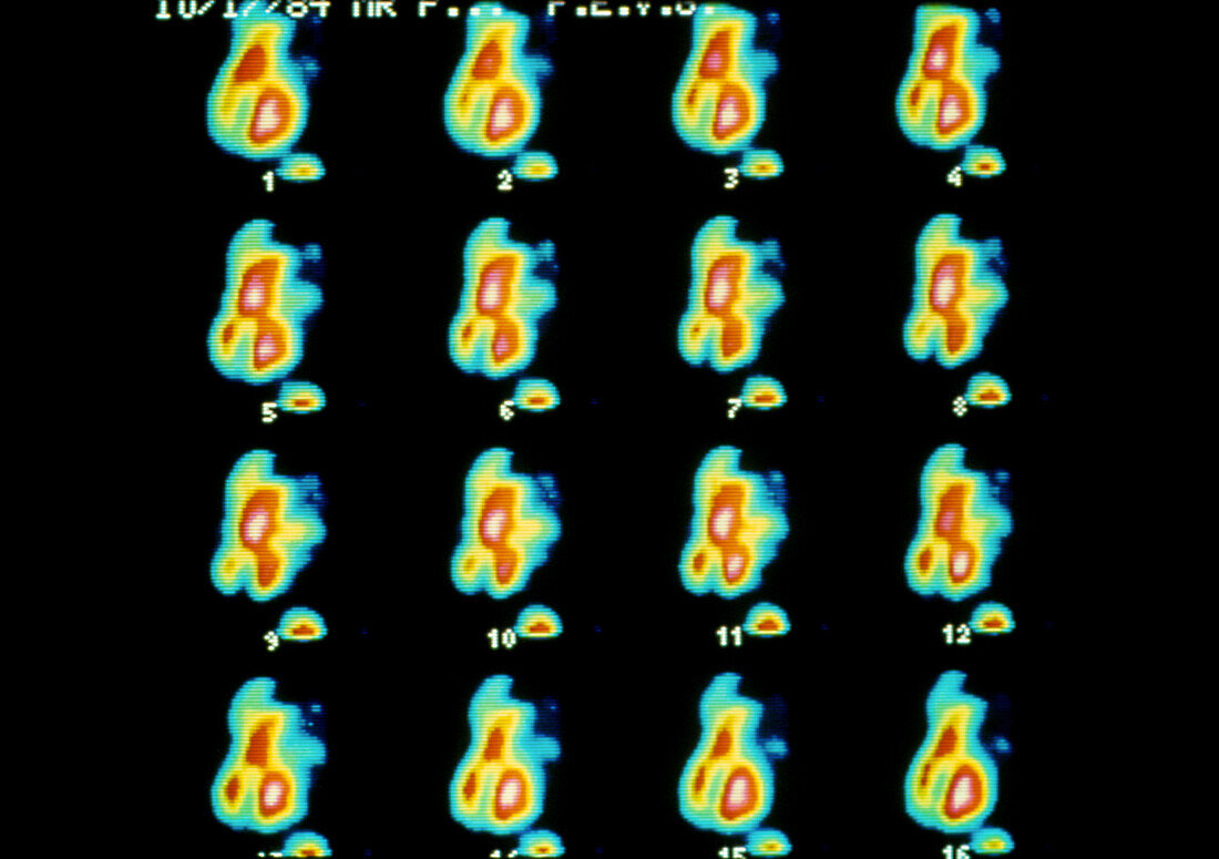 Series of gamma scans of blood flow in the heart