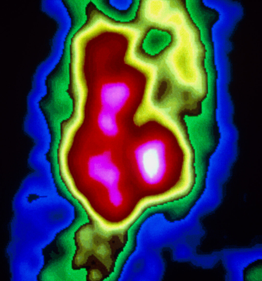 Gamma scan of heart during diastole
