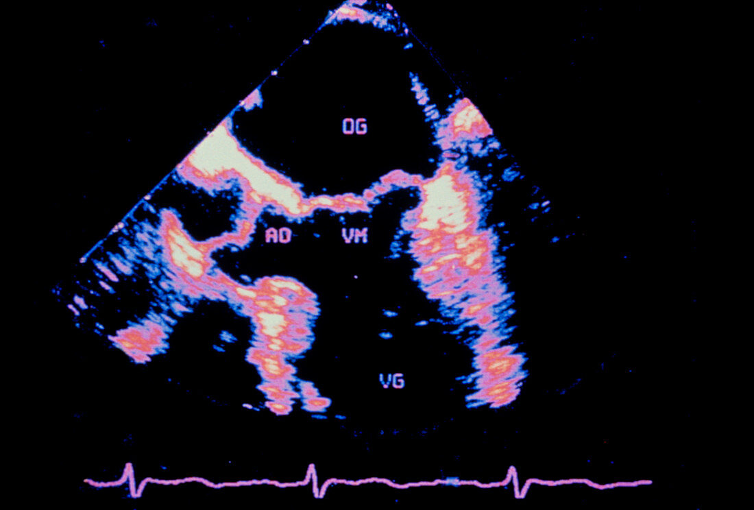 Coloured ultrasound scan of a normal heart