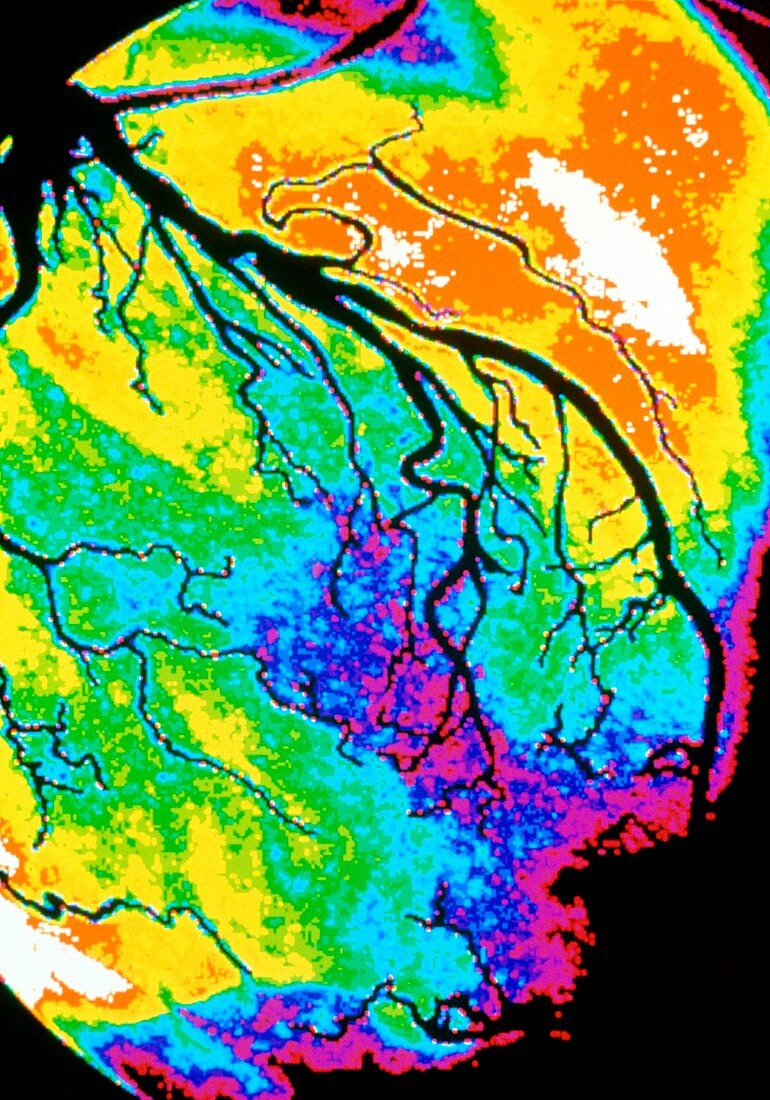 Coloured angiogram of coronary artery of the heart