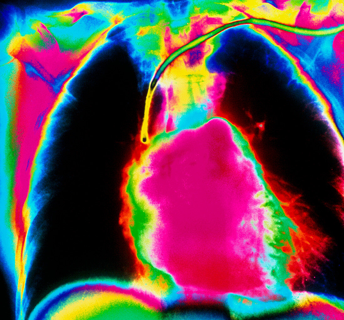 Coloured pulmonary angiogram showing healthy heart