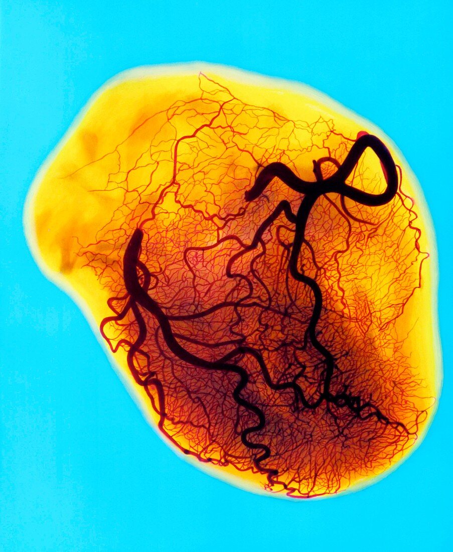 Coloured X-ray of coronary arteries of the heart