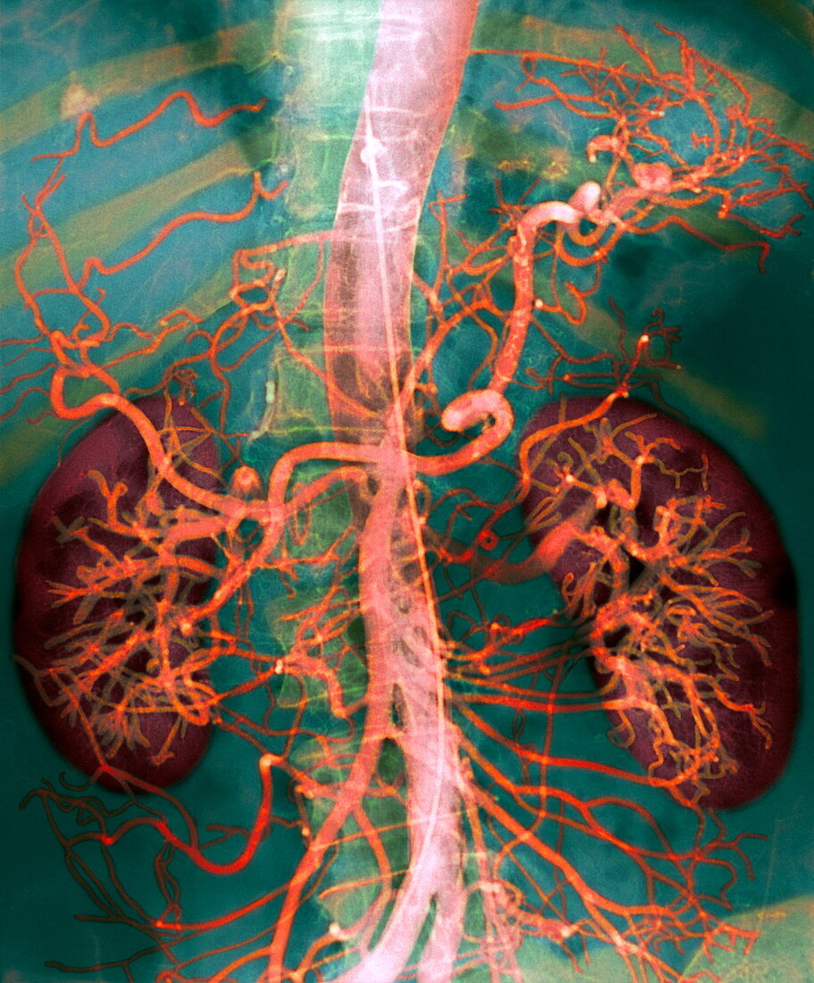 Abdominal arteries,X-ray