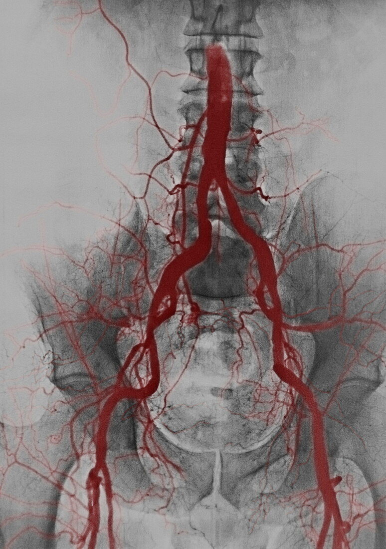 Abdominal arteries,X-ray