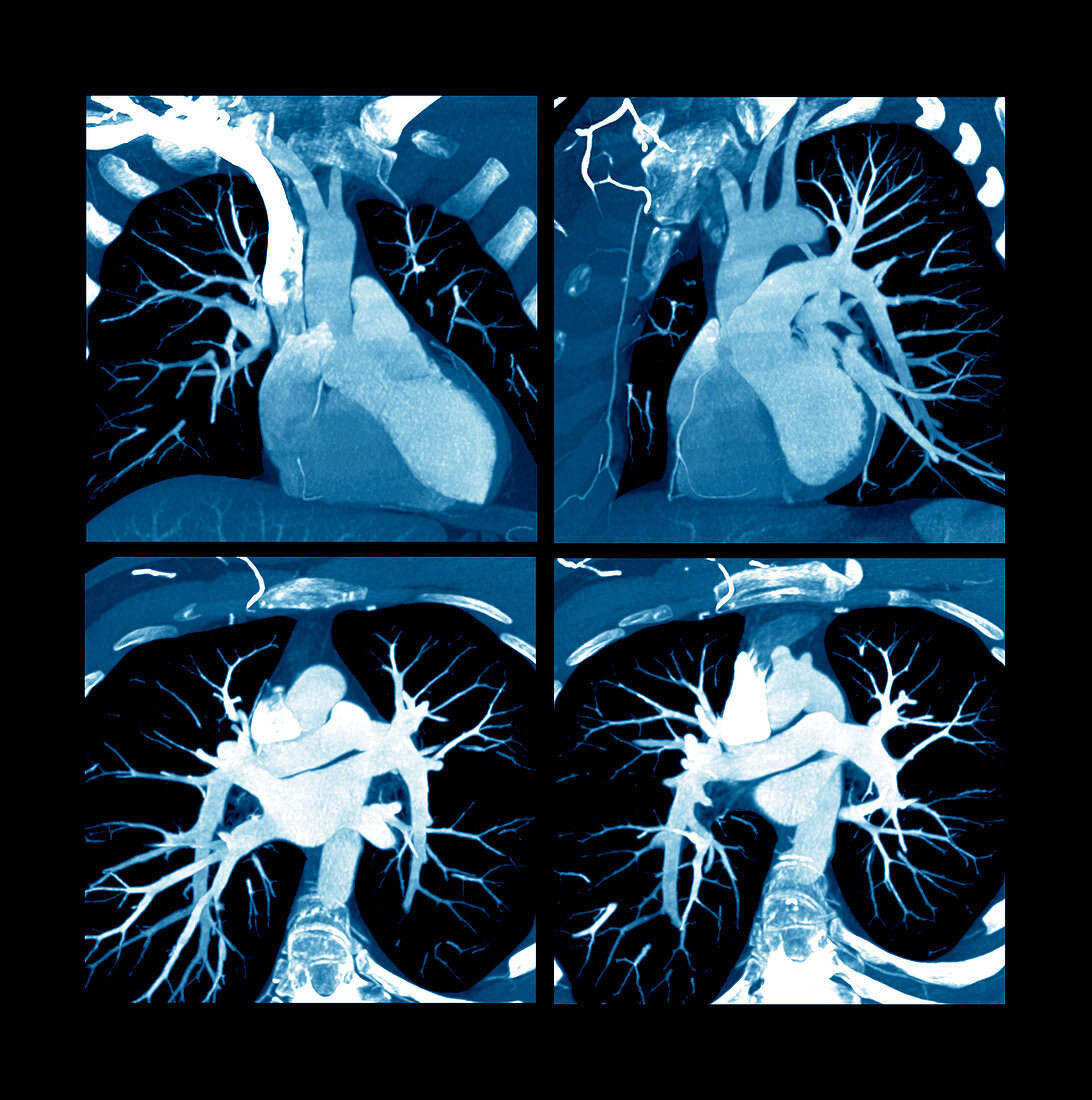Heart,CT scan
