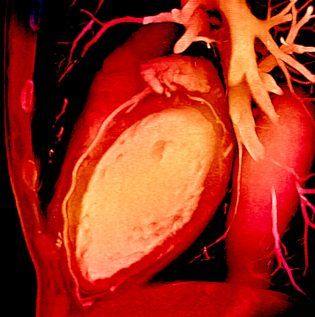 Heart and coronary arteries,3D CT scan