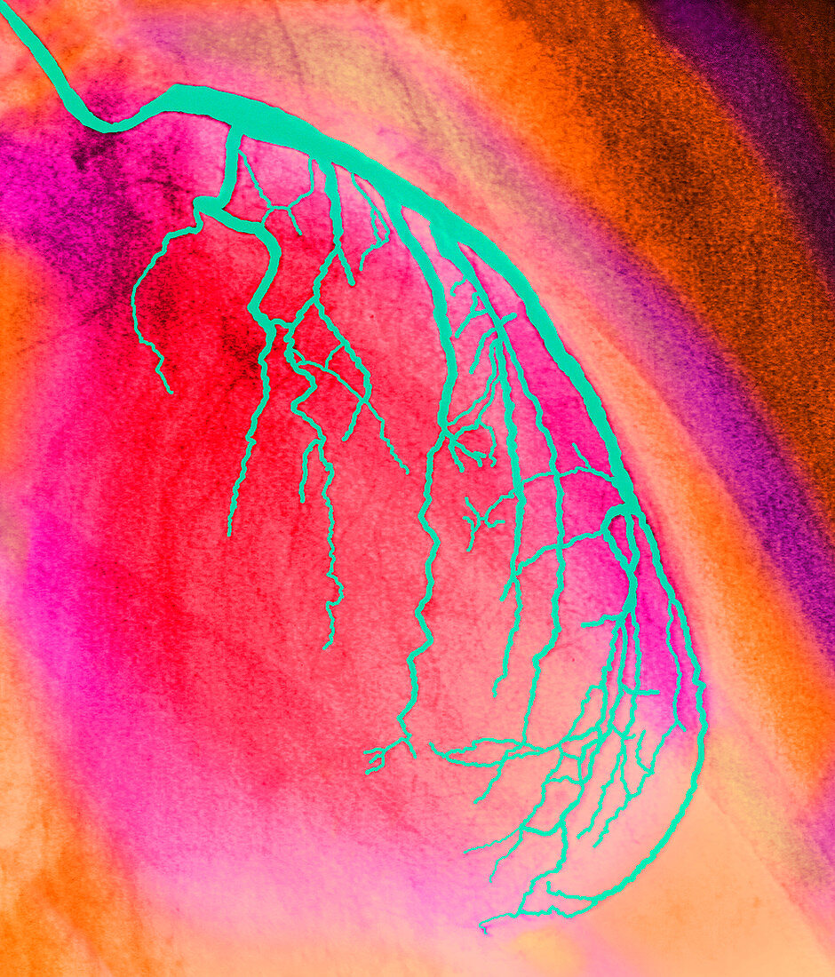 Coloured angiogram of coronary artery of the heart